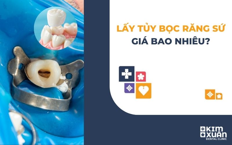Lấy Tủy Bọc Răng Sứ Giá Bao Nhiêu