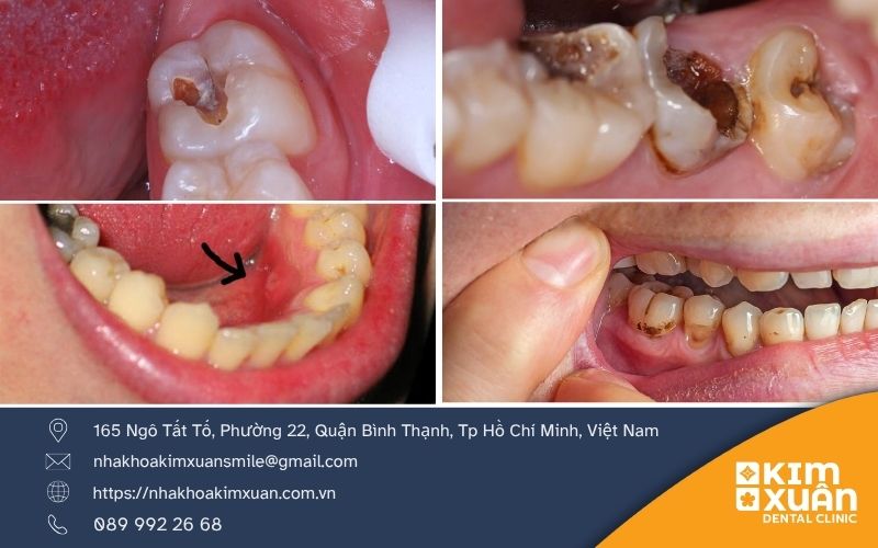 Lấy Tủy Răng Chữa Tủy Có Đau Không