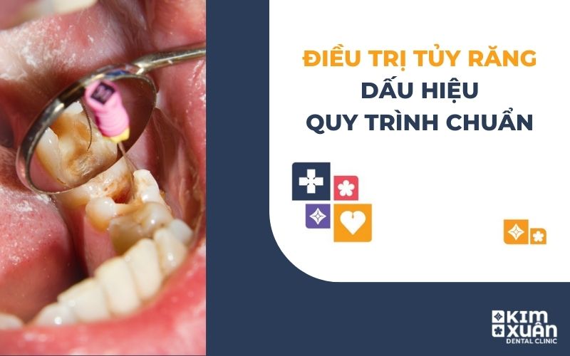 Lấy Tủy Răng - Điều Trị Tủy Răng