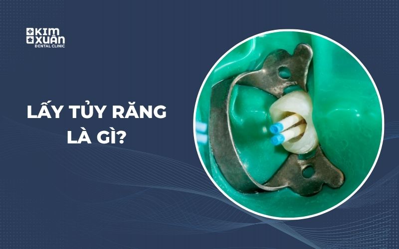 Lấy Tủy Răng