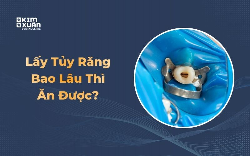 Lấy tủy răng bao lâu thì ăn được