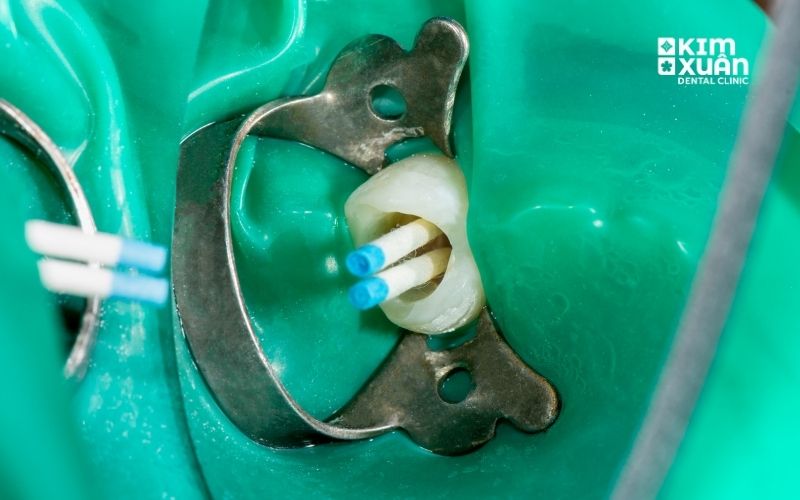 Lấy Tủy Giá Bao Nhiêu 