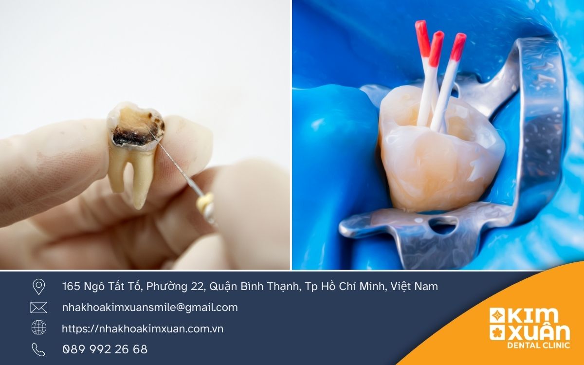 Lấy Tủy Răng Có Đau Không?