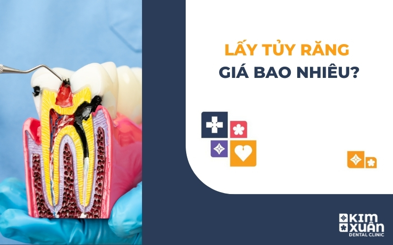Lấy Tủy Răng Giá Bao Nhiêu