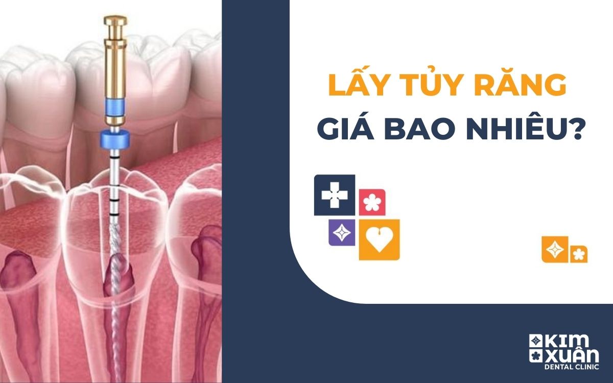 Lấy Tủy Răng Giá Bao Nhiêu