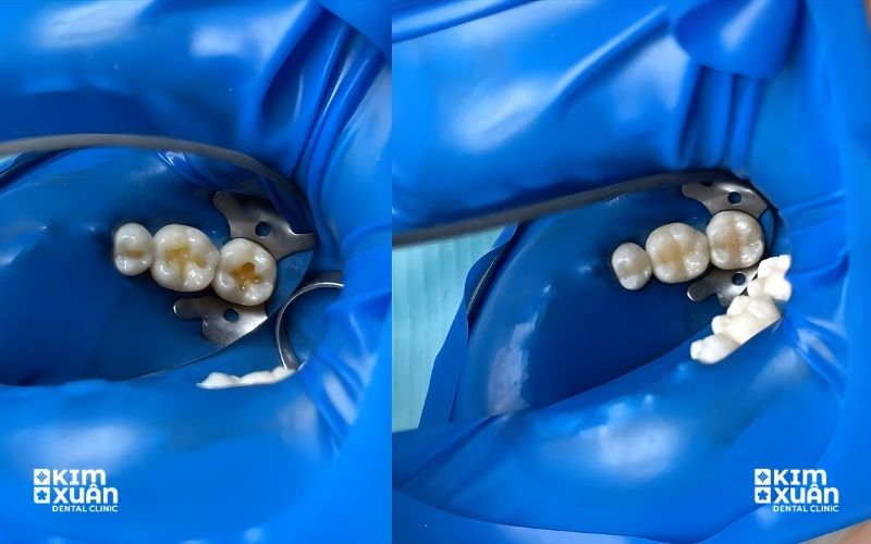 Lấy Tủy Răng Giá Bao Nhiêu Tại Nha Khoa Kim Xuân