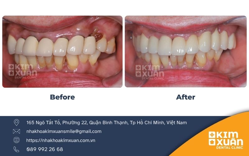 Lấy Tủy Răng Khi Bọc Răng Sứ Có Ảnh Hưởng Gì Không