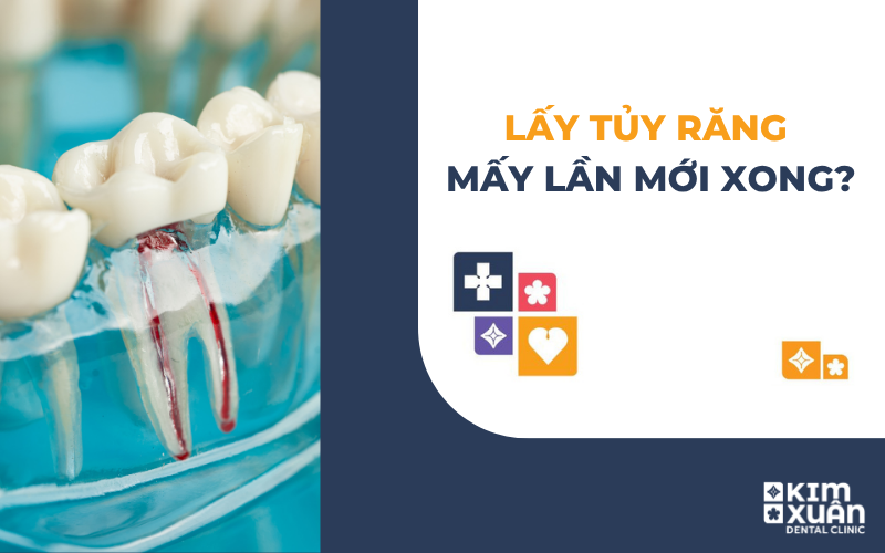 Lấy Tủy Răng Mấy Lần Mới Xong