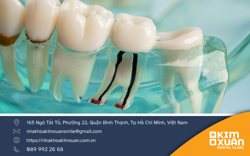 Lấy Tủy Răng Mấy Lần Thì Hoàn Tất