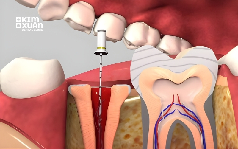 Lấy Tủy Răng Nha Khoa Kim Xuân