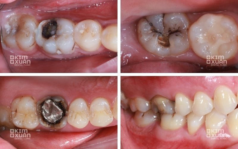 Lấy Tủy Răng Tại Nha Khoa Kim Xuân