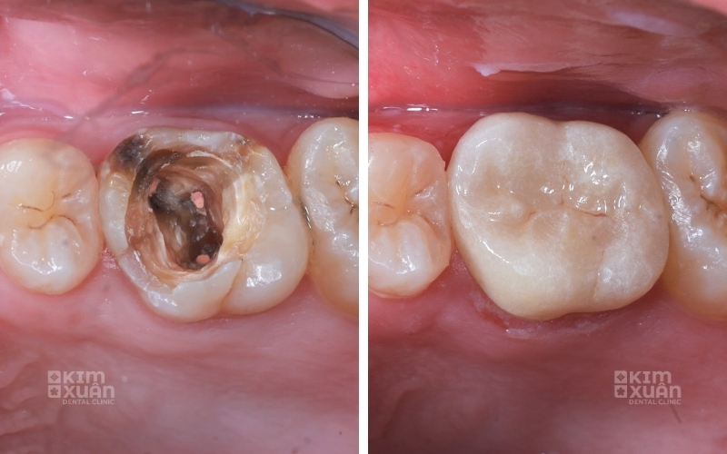 Lấy Tủy Răng Trước và Sau