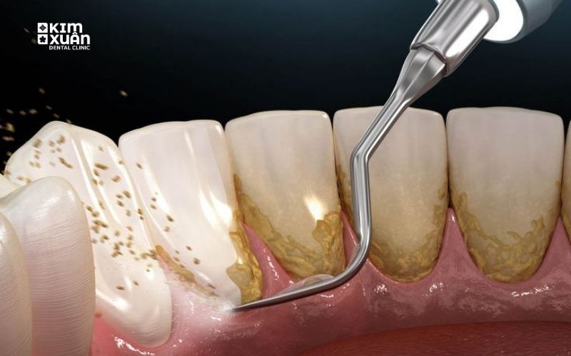 Lấy Vôi Răng Có Tốt Không