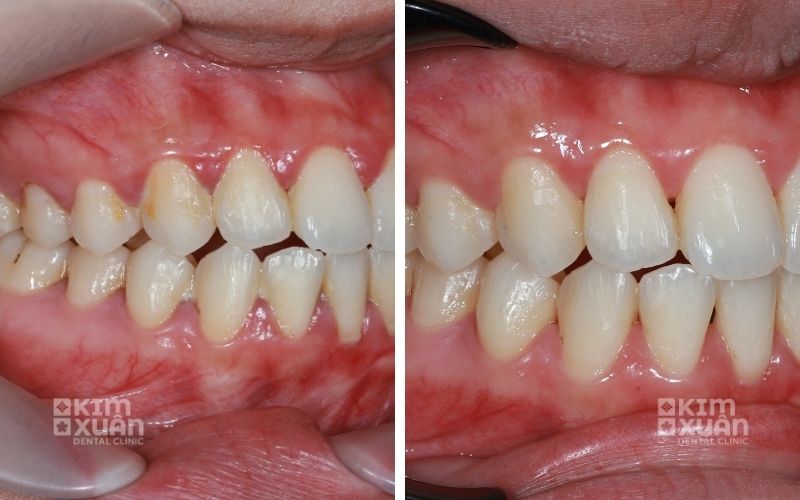 Lấy Cao Răng Nha Khoa Kim Xuân Bình Thạnh