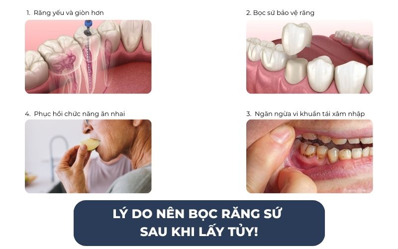 Lý Do Nên Bọc Răng Sứ Sau Khi Lấy Tủy