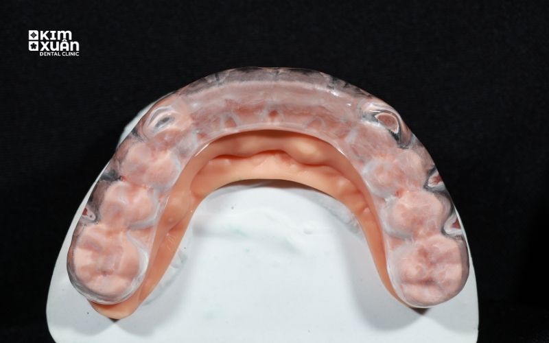 Máng Chống Nghiến Răng Cá Nhân Hóa