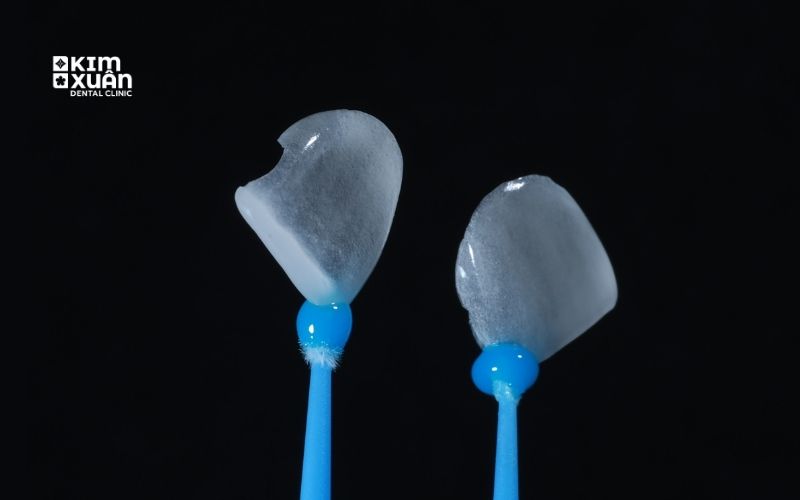 Mặt Dán Sứ Veneer 2 Răng Cửa Thưa