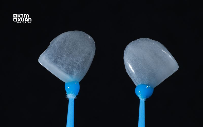 Mặt Dán Sứ Veneer Siêu Mỏng