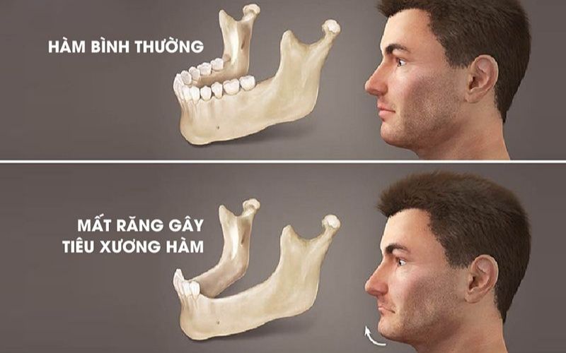 Mất Răng Bao Lâu Thì Tiêu Xương Hàm