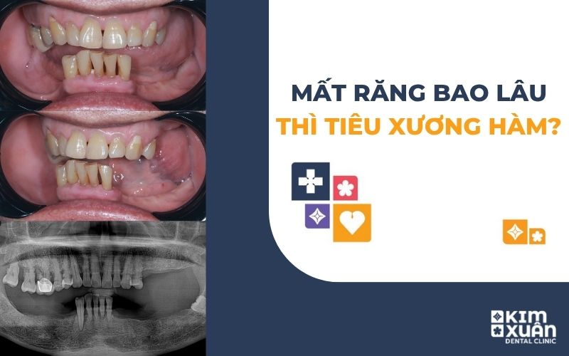 Mất Răng Bao Lâu Thì Bị Tiêu Xương Hàm