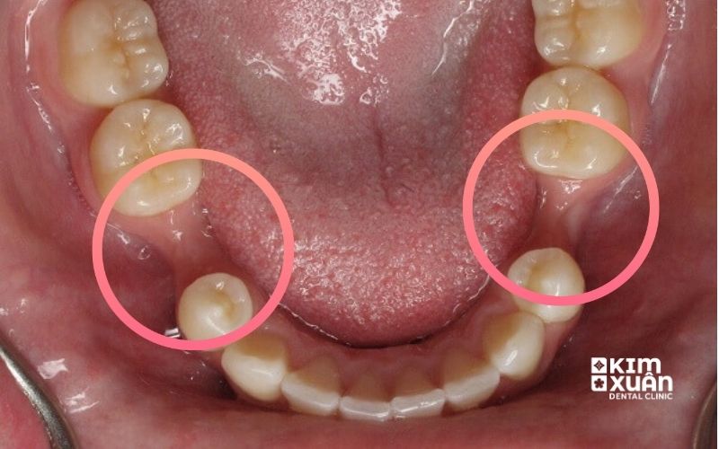 Mất Răng Bị Tiêu Xương Hàm