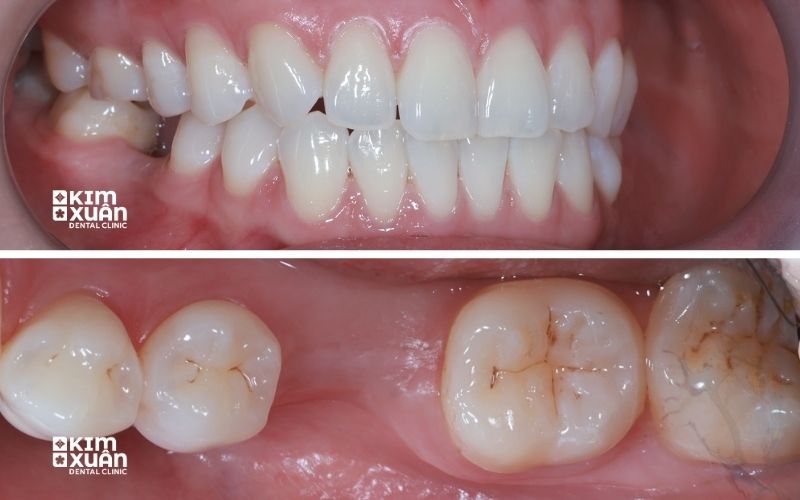 Mất Răng Có Chỉnh Nha được Không