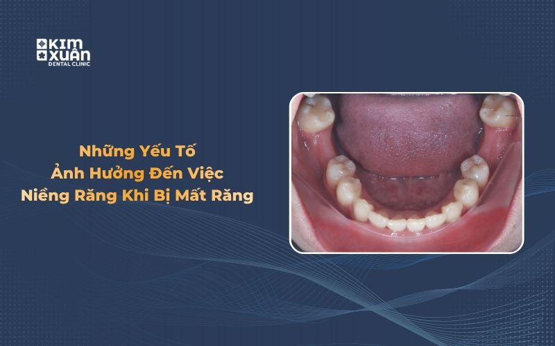 Mất răng có niềng răng được không và những yếu tố cần đánh giá