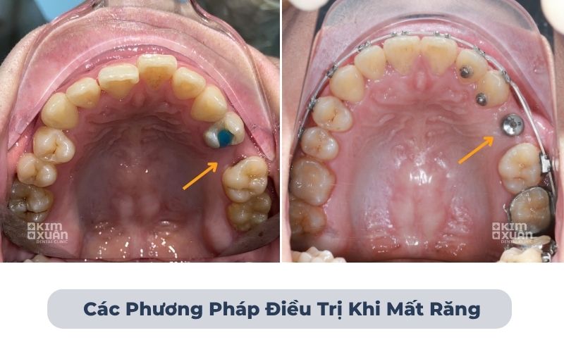 Các phương pháp điều trị khi mất răng trong chỉnh nha