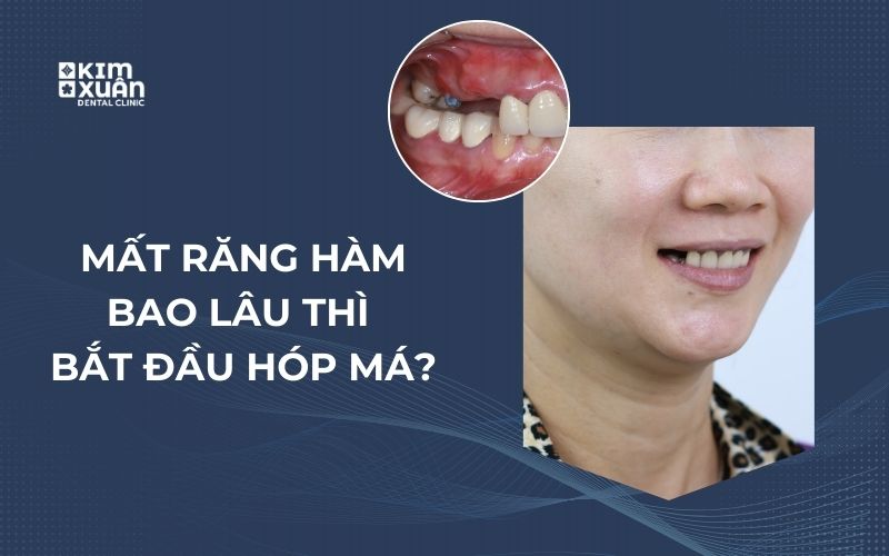Mất Răng Hàm Bao Lâu Thì Bắt Đầu Bị Hop Má
