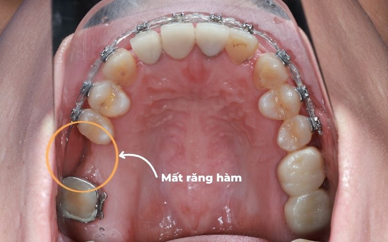 Hình ảnh mất răng hàm trong quá trình niềng răng