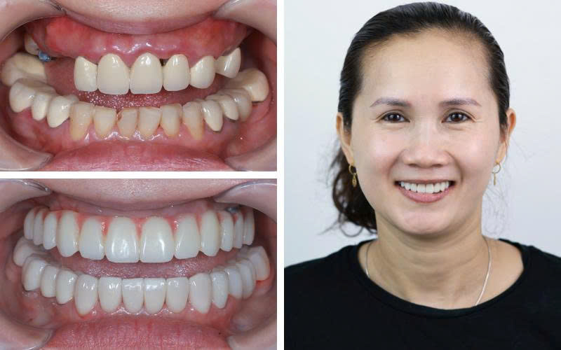 Mất Răng Lâu Năm Có Trồng Lại Được Không