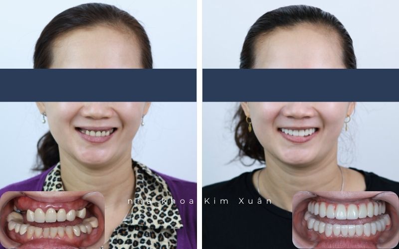 Mất Răng Lâu Năm Có Trồng Răng Implant Được Không