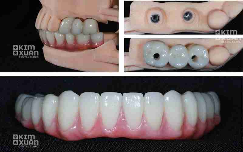 Mất Răng Lâu Năm Có Trồng Răng Implant Được Không?