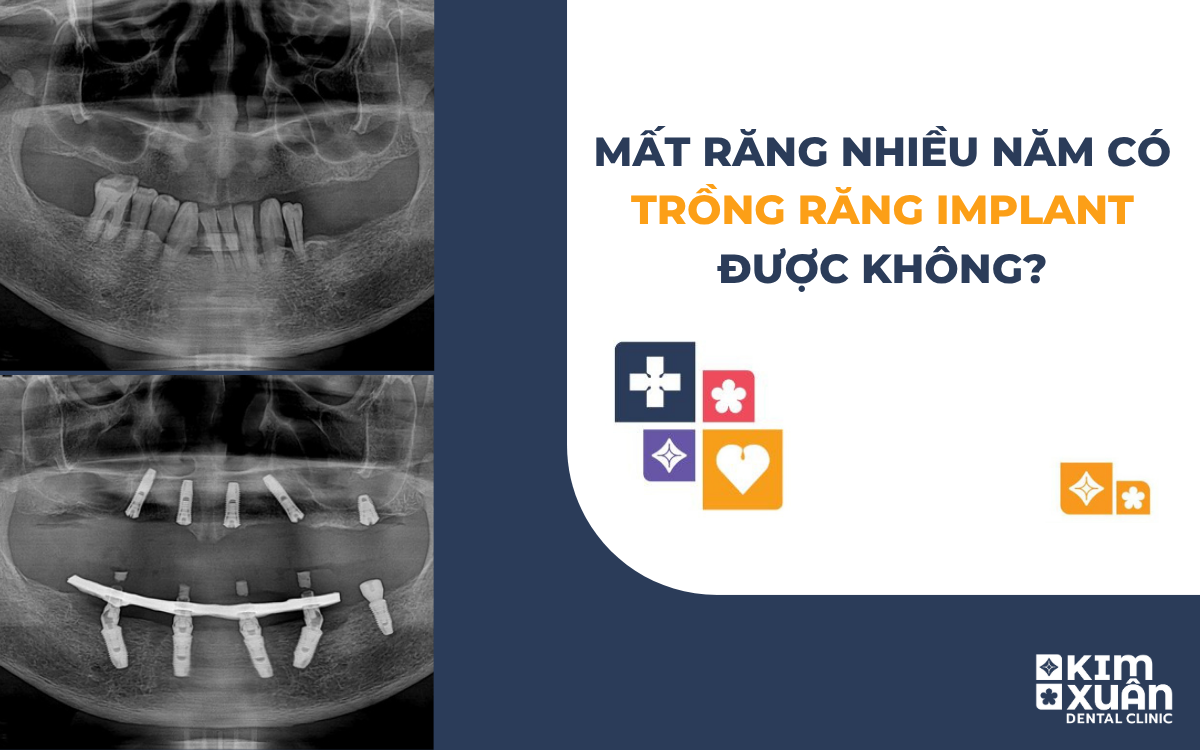 Mất Răng Nhiều Năm Có Trồng Răng Implant Được Không
