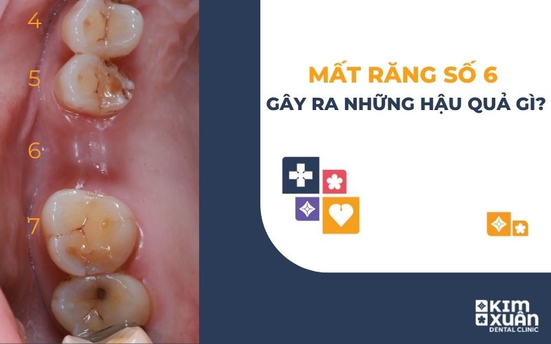 Mát Răng Số 6 Có Sao Không