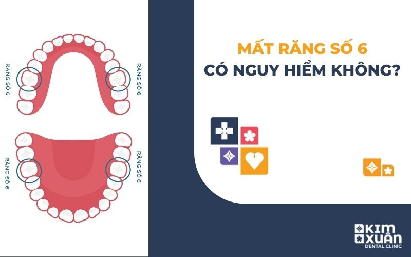 Mất Răng Số 6 Có Sao Không