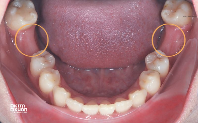 Mất răng số 6 lâu năm có trồng răng implant được không
