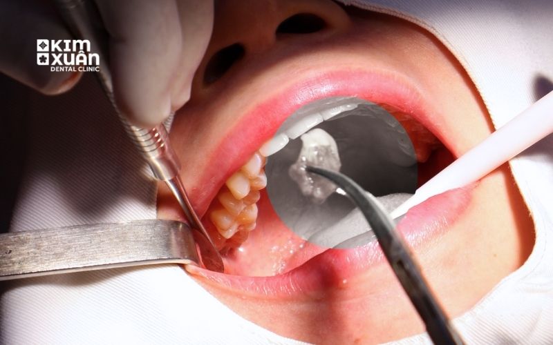 Nên Ăn Gì Kiêng Gì Sau Khi Nhổ Răng