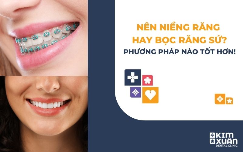 Nên Niềng Răng Hay Bọc Răng Sứ Tốt Hơn