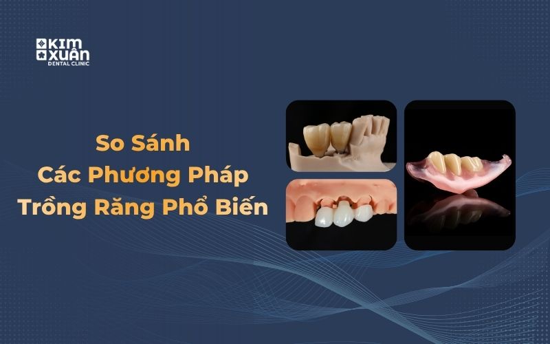 Nên Trồng Răng Sứ Hay Trồng Răng Implant