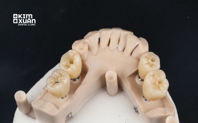 Nên Trồng Răng Sứ Vĩnh Viên Loại Nào