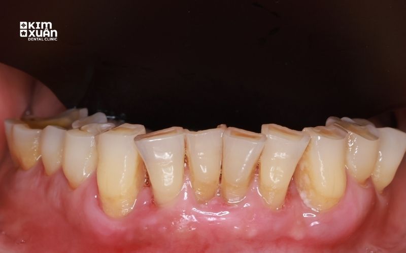 Nghiến Răng làm Mòn Răng