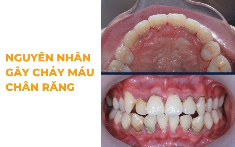 Nguyên Nhân Chảy Máu Chân Răng