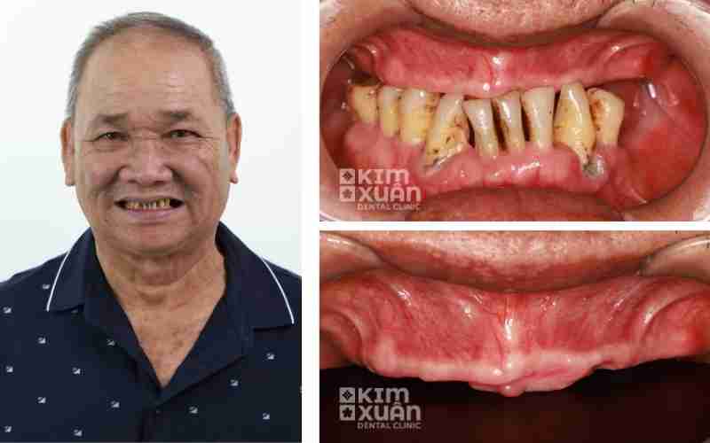 Nguyên Nhân Dẫn Đến Mất Răng Lâu Năm