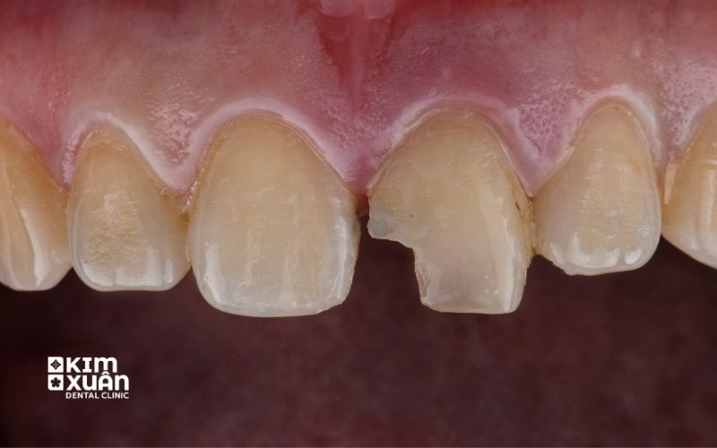 Nguyên Nhân Dẫn Đến Răng Bị Mẻ