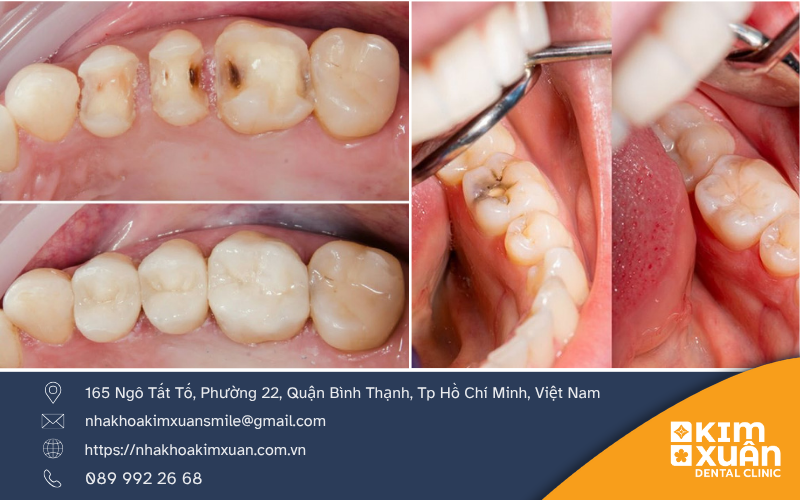 Nguyên Nhân Gây Bệnh Sâu Răng