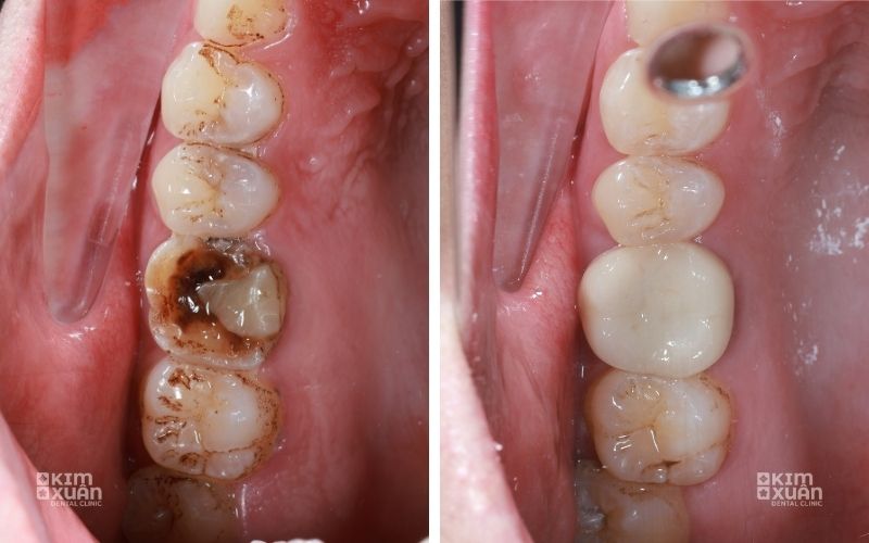 Nguyên Nhân Gây Ê Buốt Răng Khi Nhai