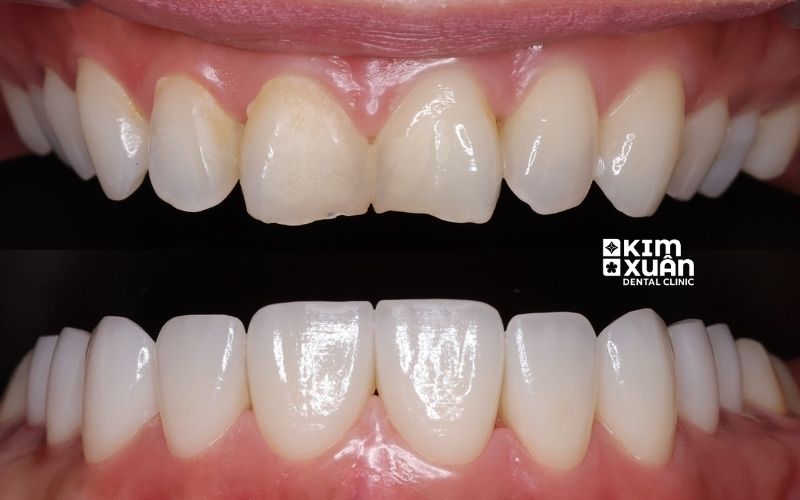 Nguyên Nhan Gây Hội Miệng Sau Khi Dán Răng Sứ Veneer