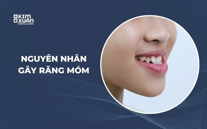 Nguyên Nhân Gây Ra Răng Móm