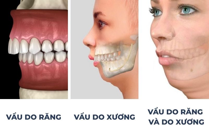 Nguyên Nhân Gây Ra Răng Vẩu